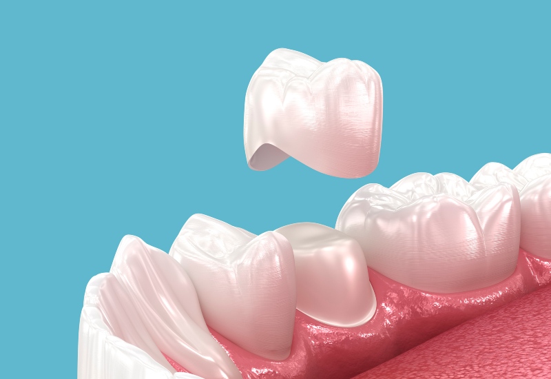 3D illustration of dental crown placed on molar tooth for restoration treatment in Livonia, MI